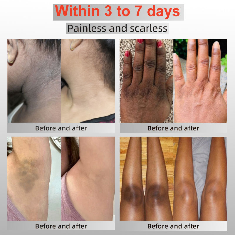 LOVILDS™ Radiance Cream for Acanthosis Nigricans, Exfoliation, Dark Spots