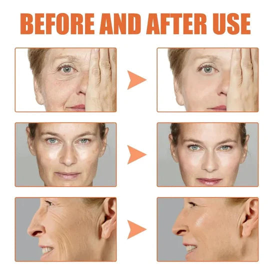 🎁Last Day Promotion 🎁-NESLEMY Salicylic Acid Extract