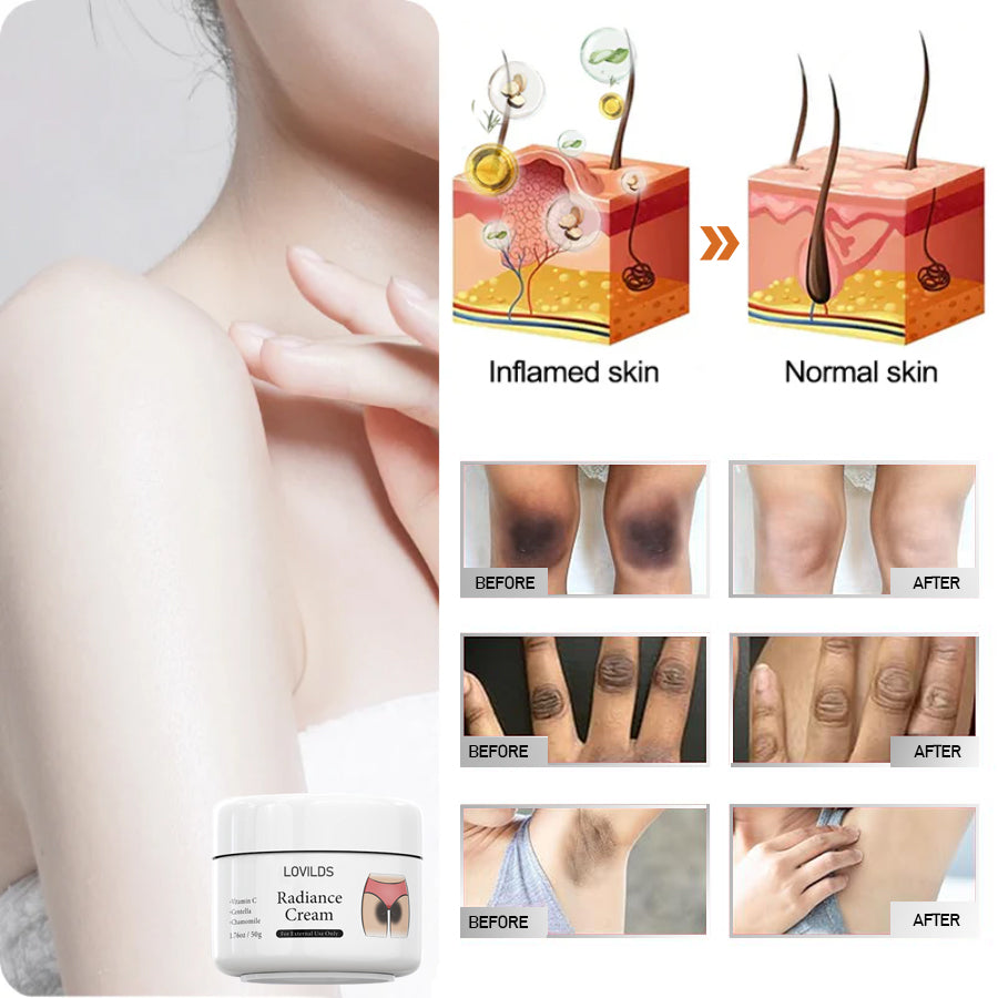 LOVILDS™ Radiance Cream for Acanthosis Nigricans, Exfoliation, Dark Spots