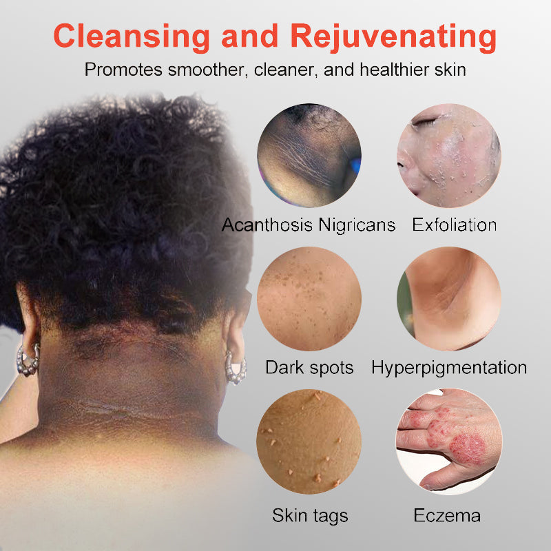 LOVILDS™ Radiance Cream for Acanthosis Nigricans, Exfoliation, Dark Spots