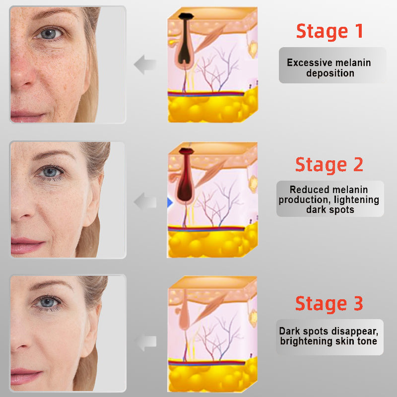 LOVILDS™ Radiance Cream for Acanthosis Nigricans, Exfoliation, Dark Spots